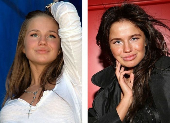 Известные россиянки до и после пластики (10 фото)