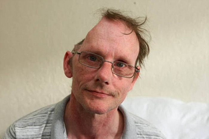 Британские власти признали трудоспособным мужчину, лишившегося части черепа (3 фото)