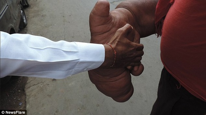 Индиец с локальным гигантизмом руки вынужден был уйти из семьи (5 фото)
