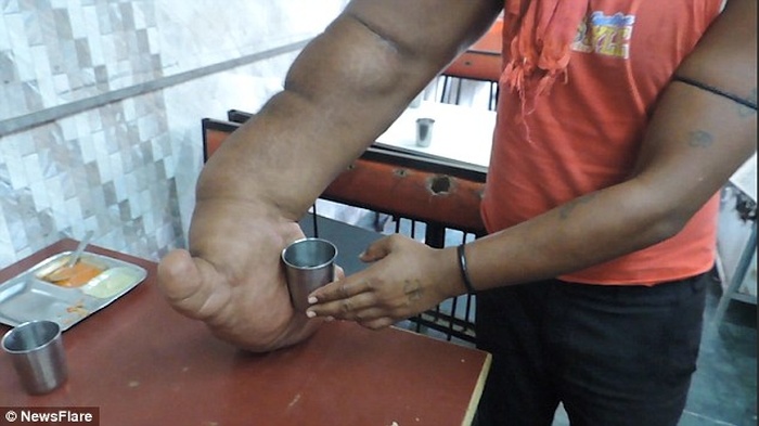 Индиец с локальным гигантизмом руки вынужден был уйти из семьи (5 фото)