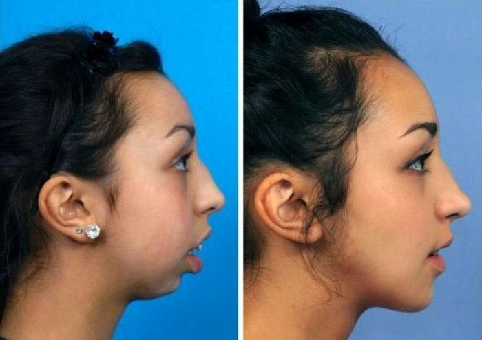 Невероятное преображение девушки с недоразвитой нижней челюстью (2 фото)