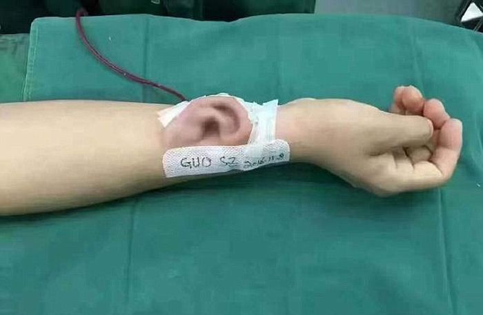 Китайские врачи вырастили ухо на руке пациента (3 фото)