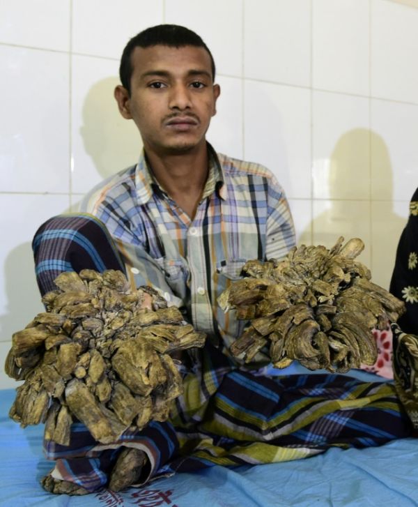 «Человек-дерево» из Бангладеш перенес 16 операций по удалению наростов на конечностях (6 фото)