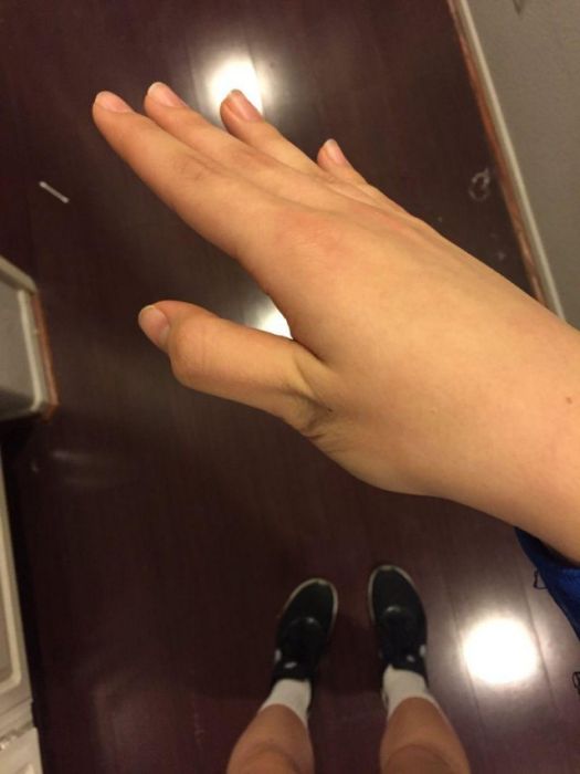 Признаки вывиха пальца на руке и способы его лечения