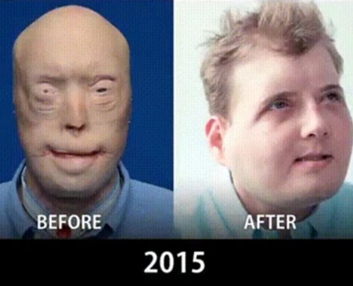 Эволюция в области пластической хирургии и пересадки лица (9 фото)