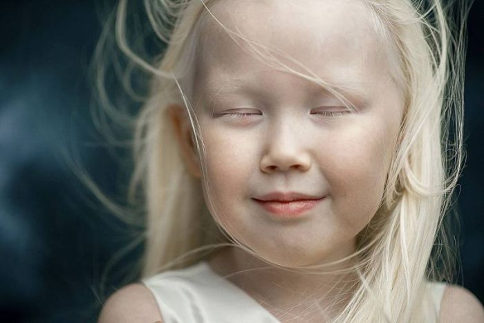 8-летняя девочка-альбинос Нарияна, которую зовут «Снежной королевой» (7 фото)