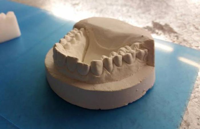 Парень выровнял зубы с помощью самодельных брекетов, напечатанных на 3D-принтере (11 фото)