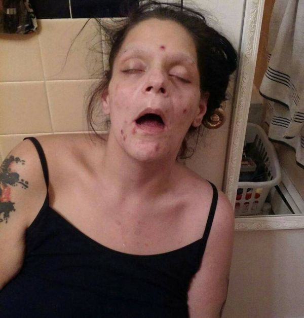 Бывшая наркоманка показала свои фото, чтобы предостеречь остальных от наркотиков  (7 фото)