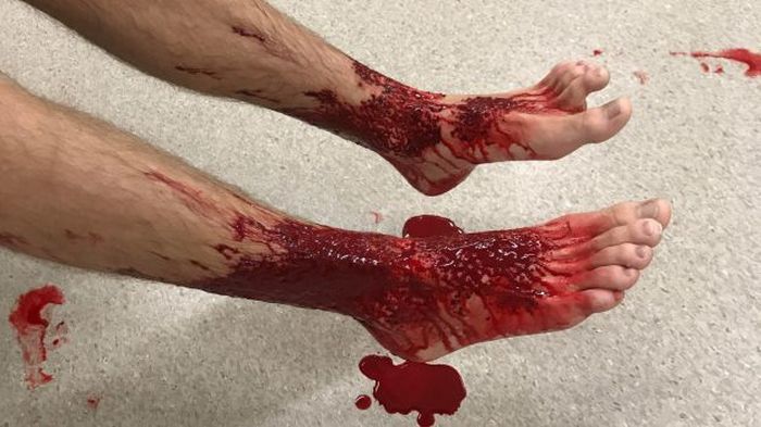 Неизвестные существа искусали ноги австралийского подростка (5 фото)