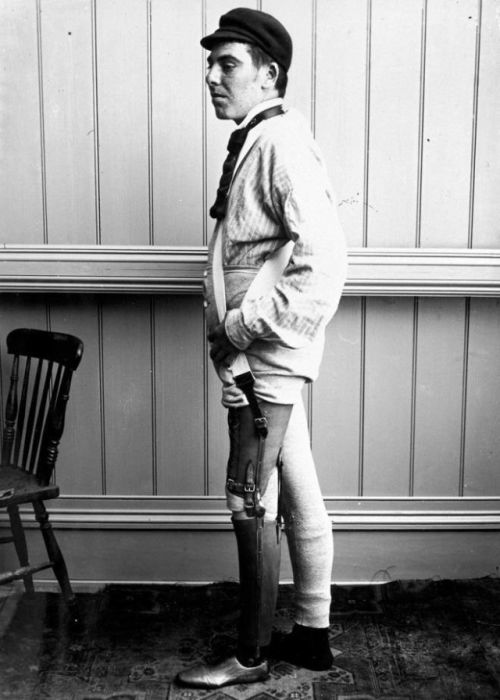Протезы Джеймса Гиллингхэма, опередившие свое время (20 фото)