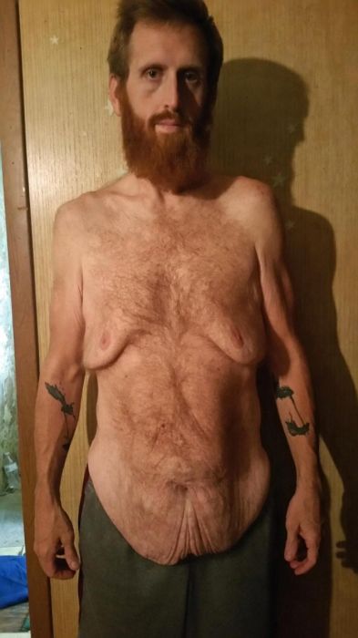 Американец похудел на 160 кг, чтобы не умереть (10 фото)