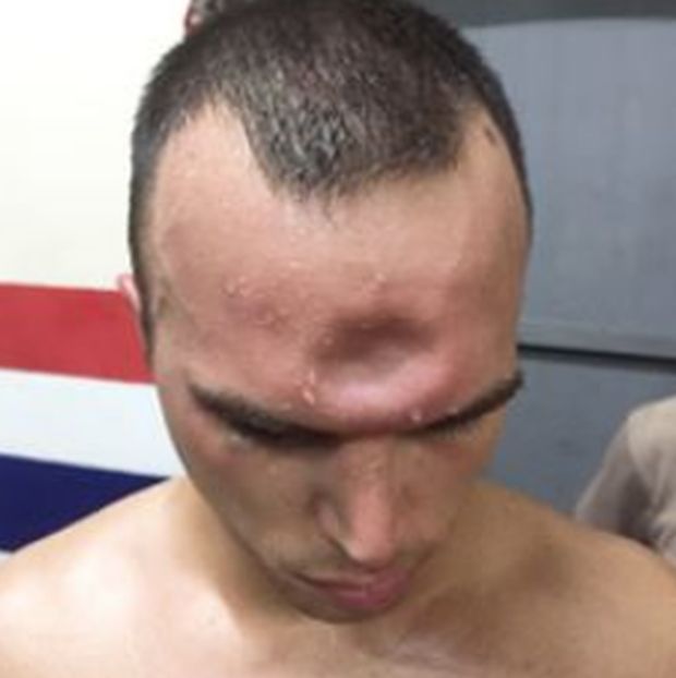 Боец муай-тай продолжал бой с проломленным черепом (3 фото)