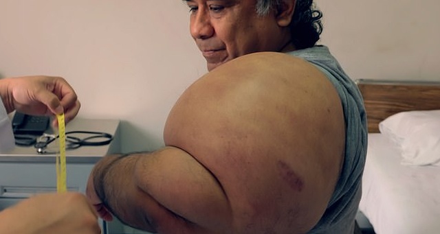 Водолаз Алехандро Рамос с раздутым из-за декомпрессионной болезни телом: год спустя (7 фото)