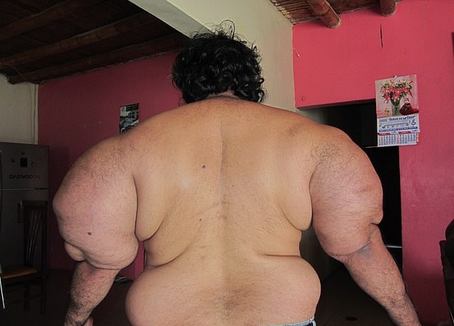 Водолаз Алехандро Рамос с раздутым из-за декомпрессионной болезни телом: год спустя (7 фото)