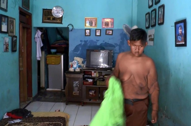 12-летний индонезийский подросток Арья Пермана похудел на 95 килограмм (9 фото)