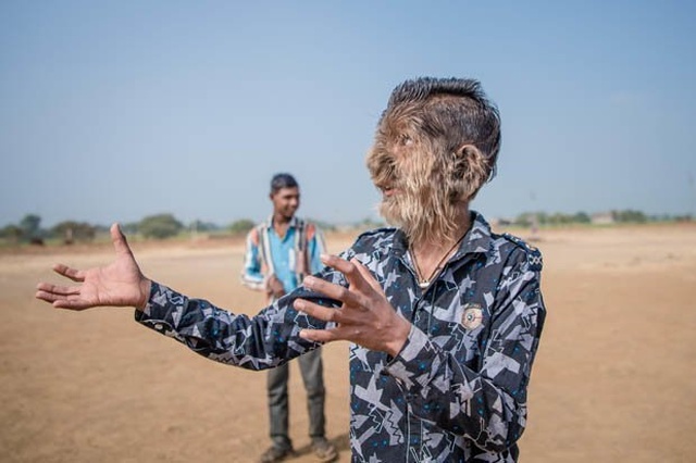 13-летний Лалит Патидар - "мальчик-оборотень" из Индии (8 фото)