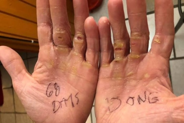 Как выглядят руки Мишель Ли, которая пересекла Атлантический океан на веслах (4 фото)