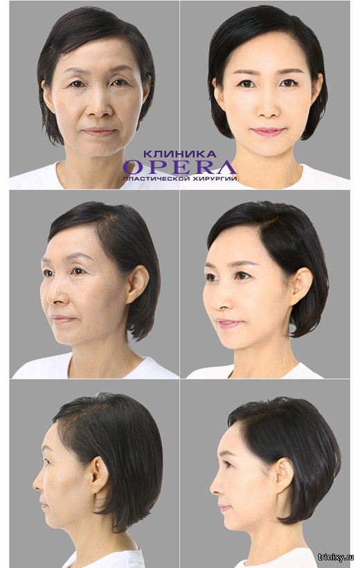Корейская пластическая хирургия с фото «до» и «после»