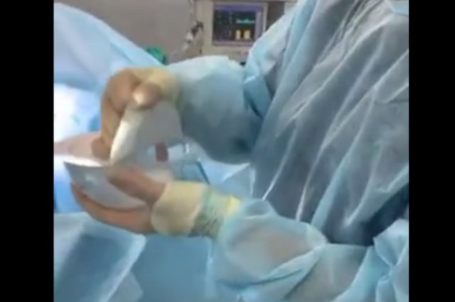 Хирург показал, чем мужья снабжают грудные импланты своих жен