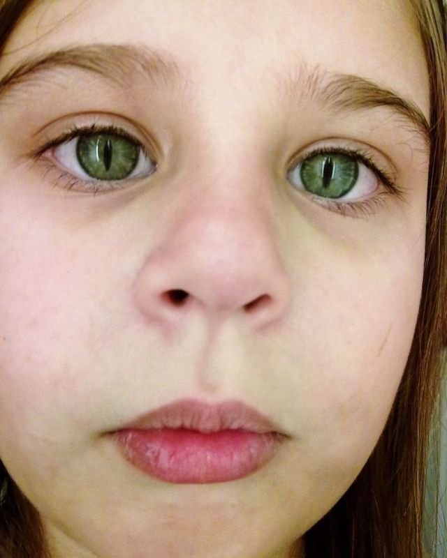Девочка с синдром кошачьего глаза