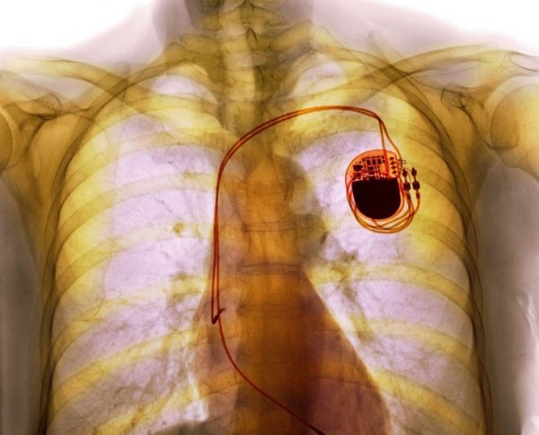 Снимок человека с кардиостимулятором