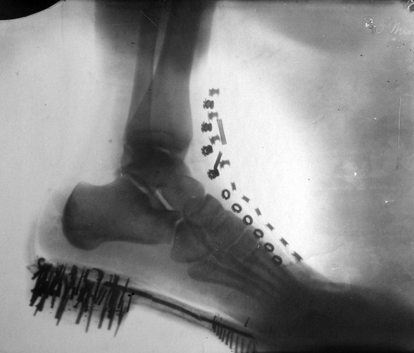 Рентген ноги Николы Теслы, который он сделал сам