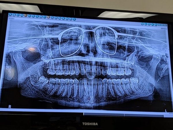 Делали панорамный рентгеновский снимок челюсти и забыли снять очки