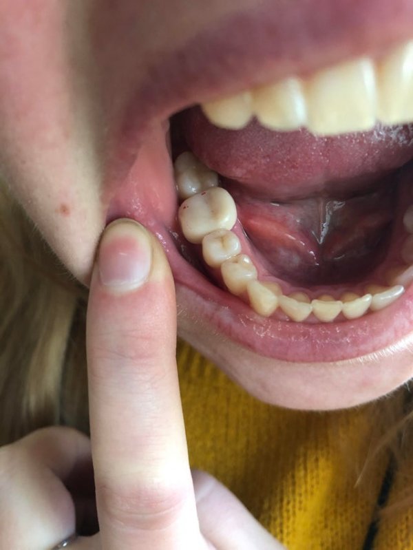 Массивный искусственный зуб в сравнении с настоящими зубами нормального размера