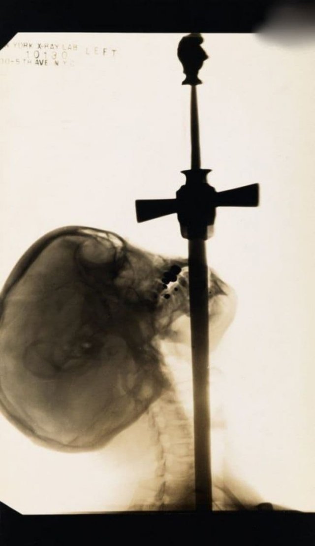 «Шпагоглотатель», 1928 г. Рентгеновский снимок шпагоглотателя.