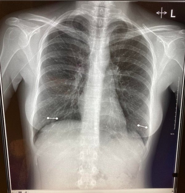 Девушка забыла снять пирсинг во время прохождения рентгена