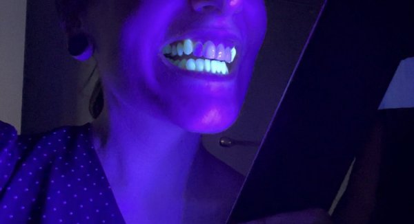 Обычные зубы светятся в ультрафиолетовом свете, а виниры — нет