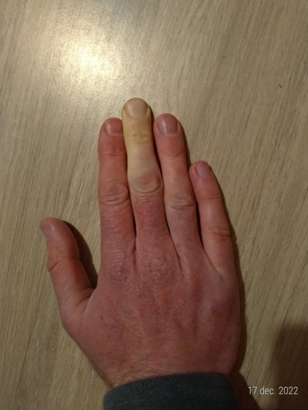 У меня есть палец, который остаётся постоянно белым