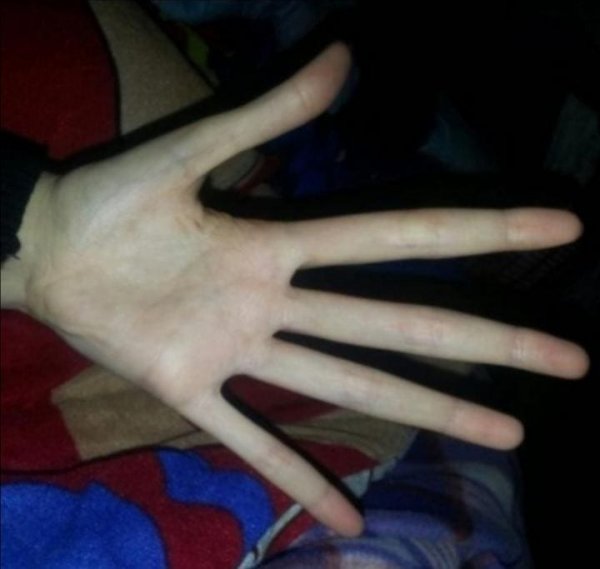 Мои руки с синдромом Марфана