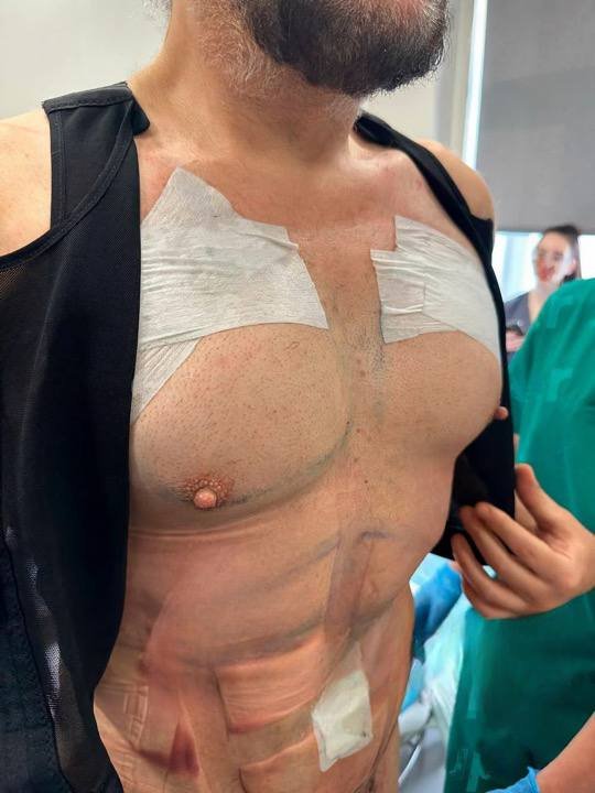 Филипп Киркоров превратился в Кена после пластической операции