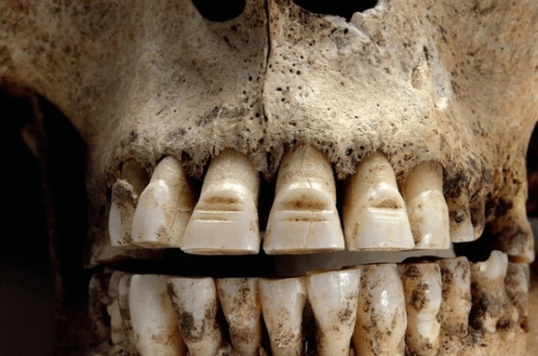 Череп викинга с подпиленными зубами, найденный в братской могиле в Дорсете, Англия
