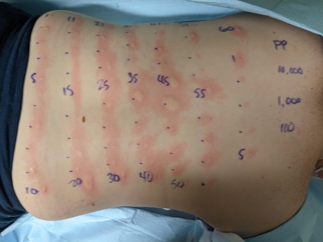 Так выглядит спина человека, проверяющегося на аллергены