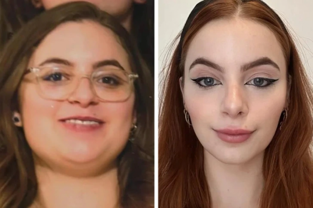 «До и после ринопластики. Раньше я ненавидела фоткаться»