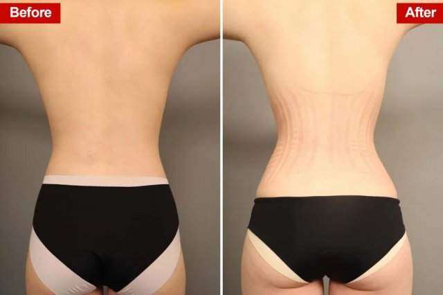 Девушки по всему миру начали массово удалять себе рёбра ради талии мечты