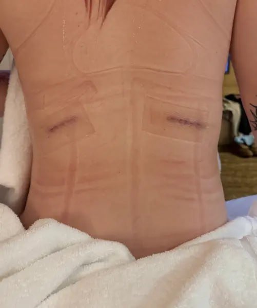 Девушки по всему миру начали массово удалять себе рёбра ради талии мечты