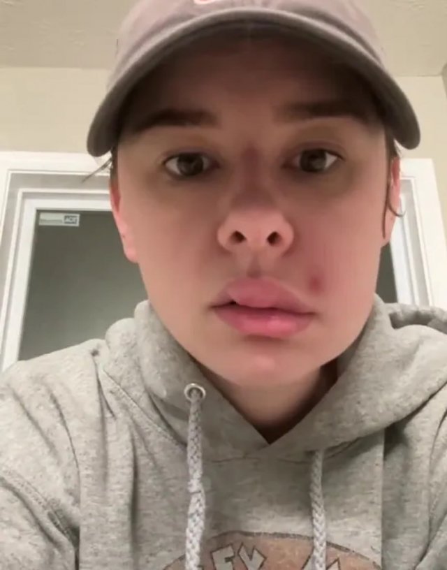 У девушки перекосило лицо от выдавленного прыща