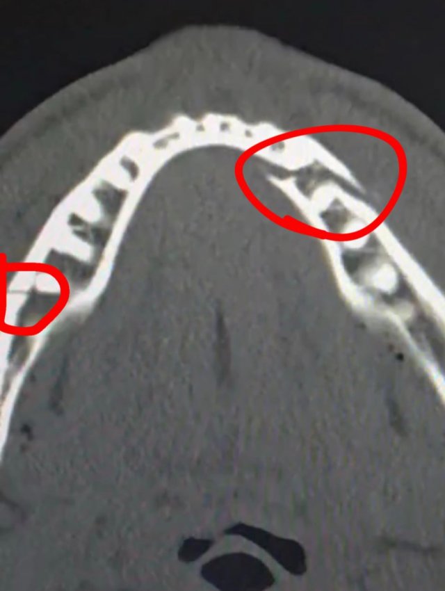 Энтони Джошуа нокаутировал блогера Джейка Пола и сломал ему челюсть в двух местах