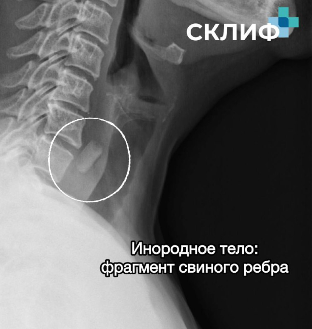 Врачи поделились необычными предметами в желудках у пациентов