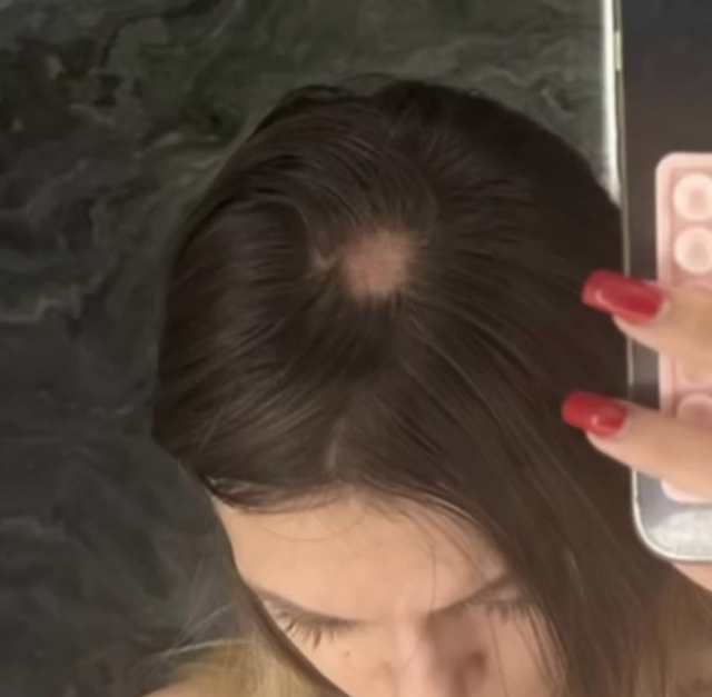 Облысение из за шапки с маркетплейса