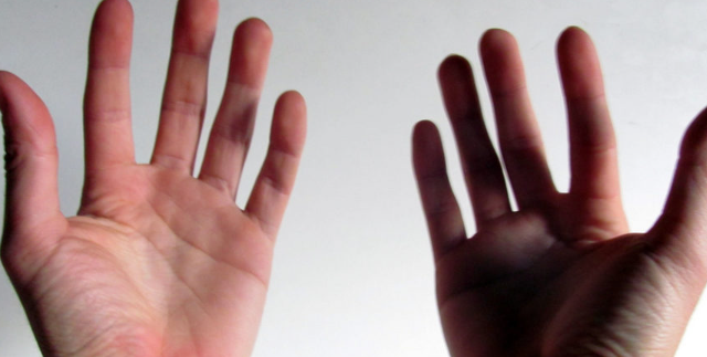 Первая успешная трансплантация рук в России