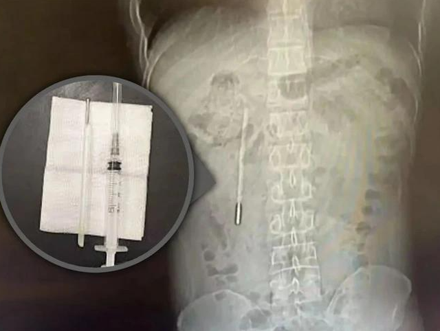 Китаец случайно носил термометр в кишечнике 20 лет