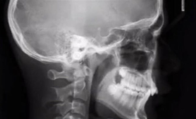 Как будет выглядеть рентген, если вы чихнете в самый неподходящий момент (2 фото)