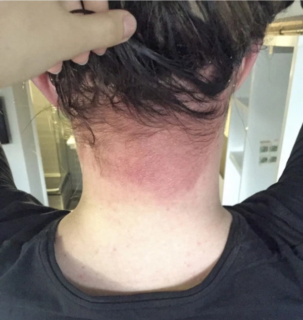 Аллергия на краску для волос (6 фото)