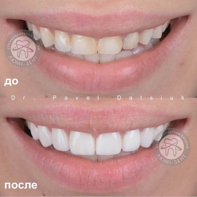 До и после установки керамических виниров на зубы