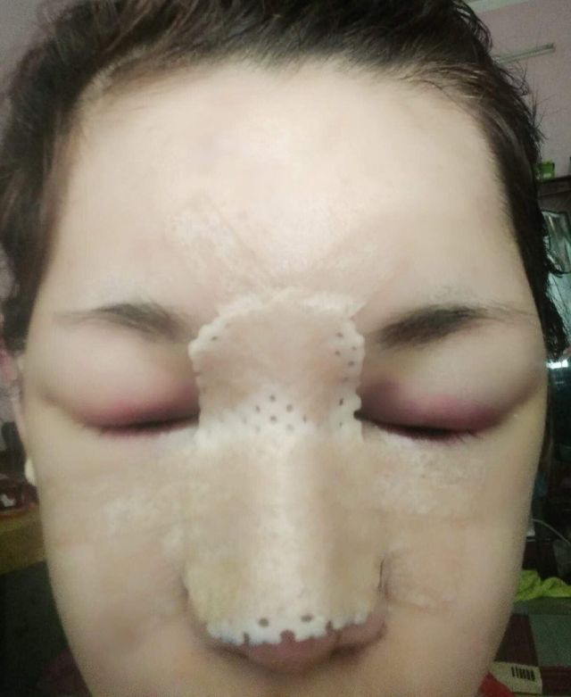 Нгуен Туонг Ви отходит от операции на носу