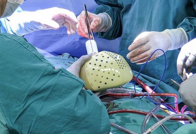 хирурги имплантируют искусственное сердце